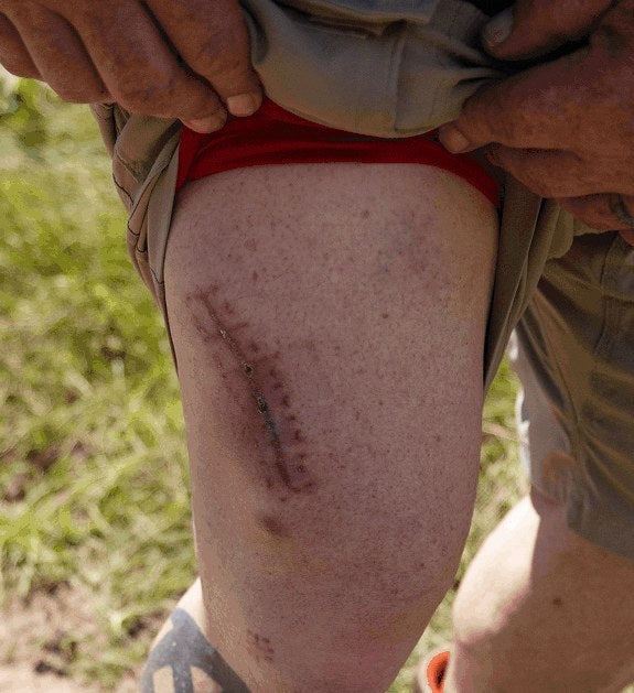 Russ’s healed leg with a long scar above the knee