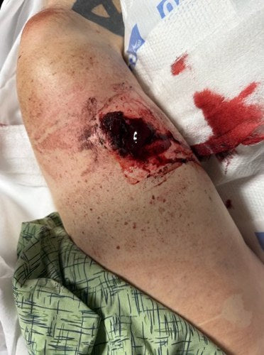 Russ’s gunshot wound on his leg, photographed at the hospital